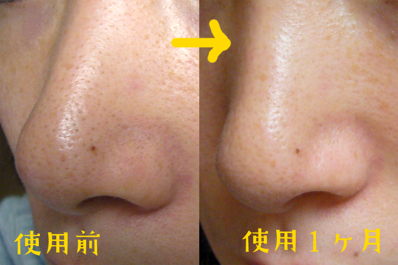 いちご鼻に効くremery リメリー の気になる評価 評判は Remery リメリー の成分はいちご鼻の改善に強力な効果あり
